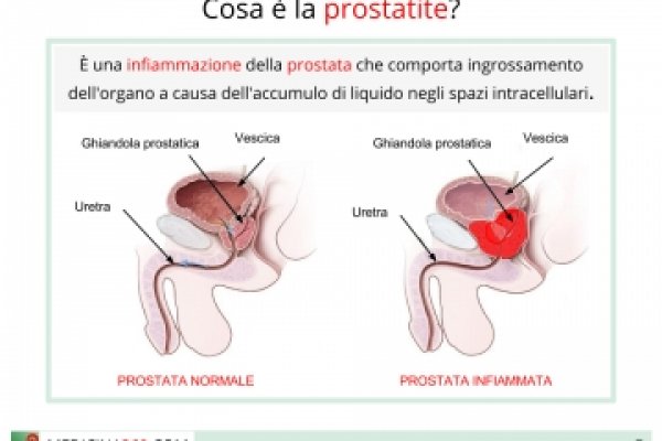 Prostata Ingrossata Effetti e Impatti sulla Salute